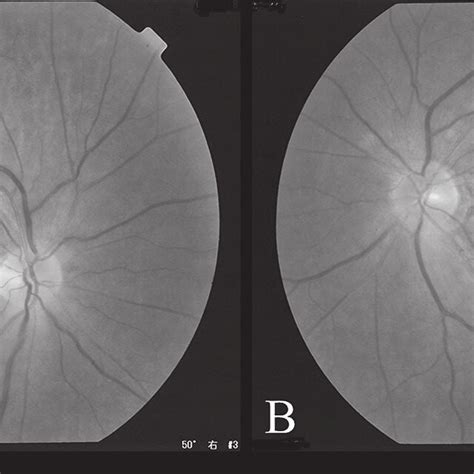 Fundus examination The examination for both the right (A) and left (B)... | Download Scientific ...