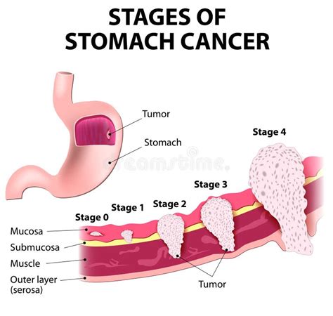 Staging of stomach cancer stock vector. Illustration of helicobacter ...