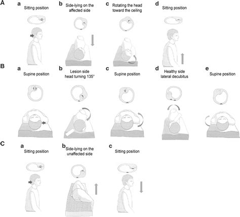 Illustrations of the Gufoni maneuver (A), mastoid oscillation (B), and ...