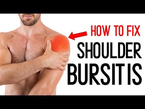 Subacromial bursitis- shoulder bursitis - subacromial bursitis ...