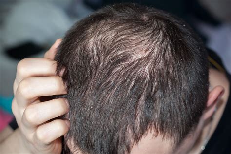 ARE DANDRUFF AND HAIR LOSS RELATED?