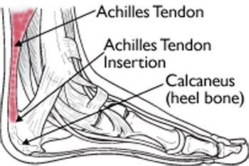 Achilles Tendinitis - Orthopedic & Sports Medicine