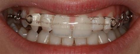 Inman Aligner Treatment For Orthodontics – How Does It Work? | Blog