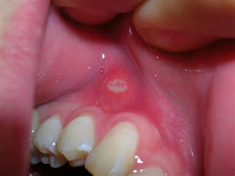 Mouth Ulcers - Canker Sores or Aphthous Stomatitis