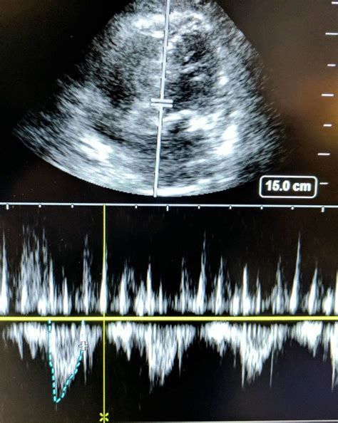 Cardiac Output With LVOT Measurements Using Echocardiography | RK.MD