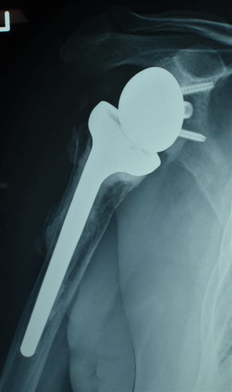 Shoulder Joint Replacement - Gold Coast Hand + Upper Limb Clinic