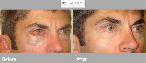 Eyelid Skin Cancer Before and After Photos | Taban MD