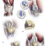 HOW TO TELL IF YOUR QUAD IS TORN - Muscle Pull | Muscle Pull