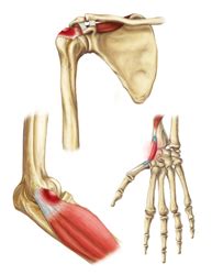 Tendinosis Injury Treatment