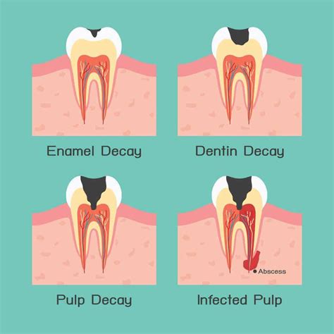 Tooth Abscess Stages Pictures : What To Look For?