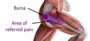 Bursitis Hip Pain Location Chart