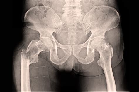 Hip Fractures - AdFrac