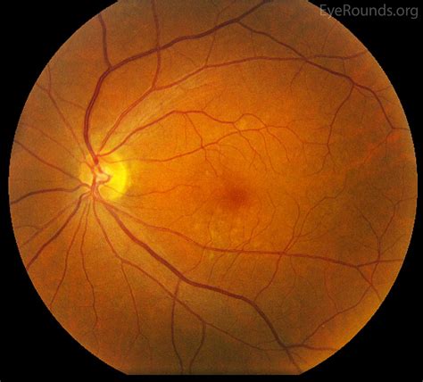 Age-related macular degeneration