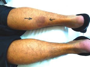 Calf Muscle Pain: Diagnosis, Symptoms & Treatment