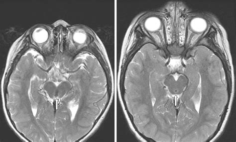 Cerebral Aqueduct Mri