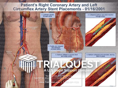 Right Coronary Artery and Left Circumflex Artery Stent Placements - TrialExhibits Inc.