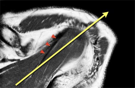 Supraspinatus Muscle Mri