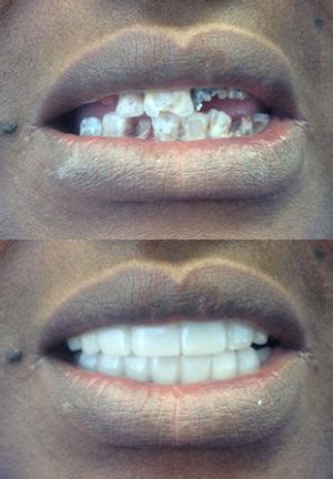 Before & After Pictures of Snap on Smile in New Orleans, LA | Gretna, LA