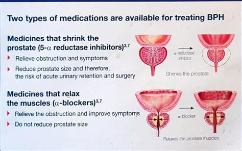 Benign Prostatic Hyperplasia (BPH) - Chin Chong Min Urology & Robotic ...