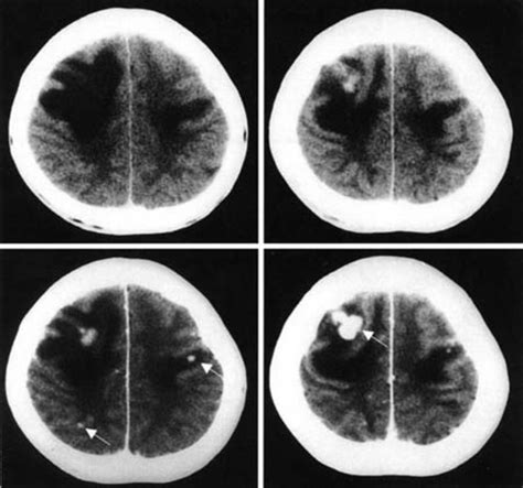 Capillary hemangioma of the central nervous system in: Journal of ...