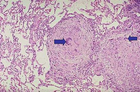 MBBS Medicine (Humanity First): Primary Tuberculosis.