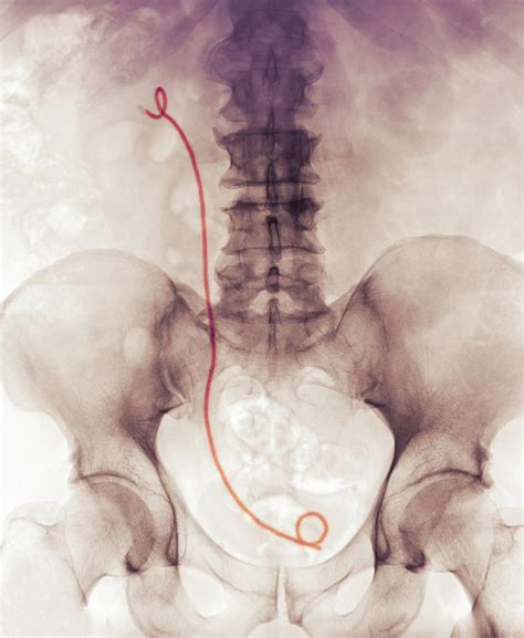 X-ray Showing A Ureteral Stent Digital Art by Callista Images - Pixels