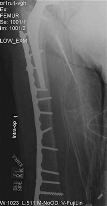 Periprosthetic Fracture: Prevention/Diagnosis/Treatment | Musculoskeletal Key