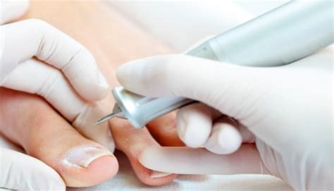 Ingrown nail treatment: Phenolisation (pheniolization)::::