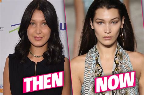 Bella Hadid Plastic Surgery Makeover Exposed By Top Doctors