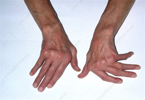 Deformed hands due to rheumatoid arthritis - Stock Image - M110/0269 - Science Photo Library