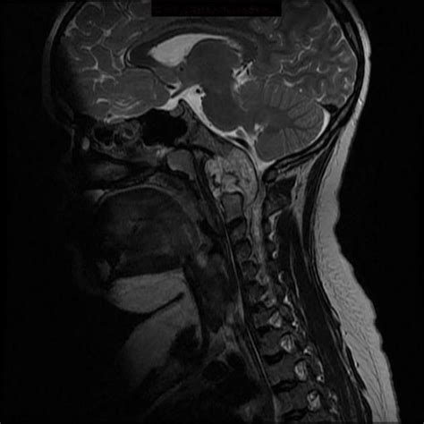 Chordoma - clivus | Radiology Case | Radiopaedia.org | Radiology, Ewing ...