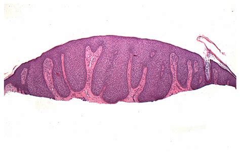 Clear Cell Acanthoma Histology