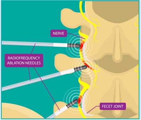 Treatments - Shore Spine & Pain