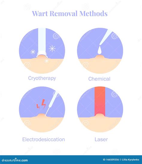 Infographics Wart Removal Methods. Cryotherapy, Electrodesiccation, Chemical and Laser Removal ...