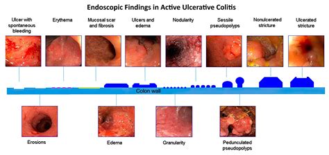 Colonoscopy Pictures Of Ulcerative Colitis