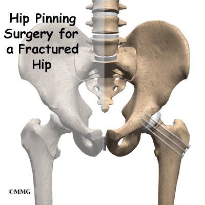 Hip Pinning Surgery for a Fractured Hip - eOrthopod.com