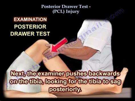 Posterior Drawer Test, PCL Injury - Everything You Need To Know - Dr. Nabil Ebraheim - YouTube