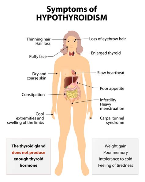 Hypothyroidism | SJFM