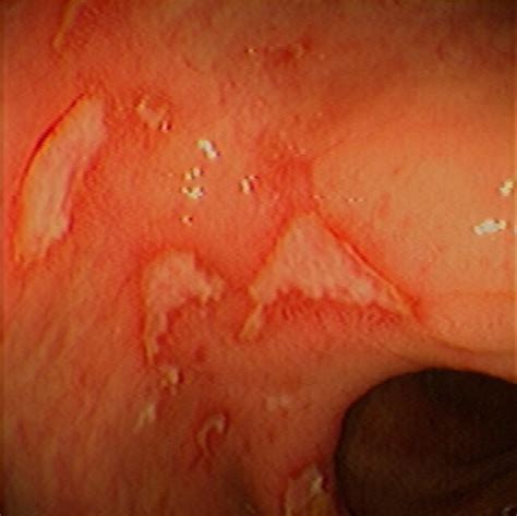 Colon: Crohn's Ulcers (#1)