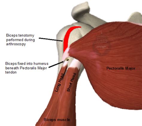 Biceps tenotomy or tenodesis