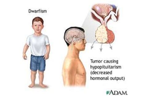 Campomelic Dysplasia (Achondroplasia)