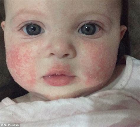 Brisbane baby with severe eczema on her face told she'll have to wait a ...