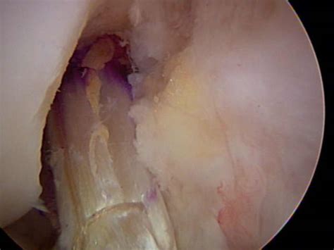 Arthroscopic ACL | UW Orthopaedics and Sports Medicine, Seattle