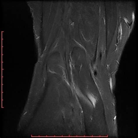 mucoid degeneration of the ACL with increased signal intensity alternating with its normal ...