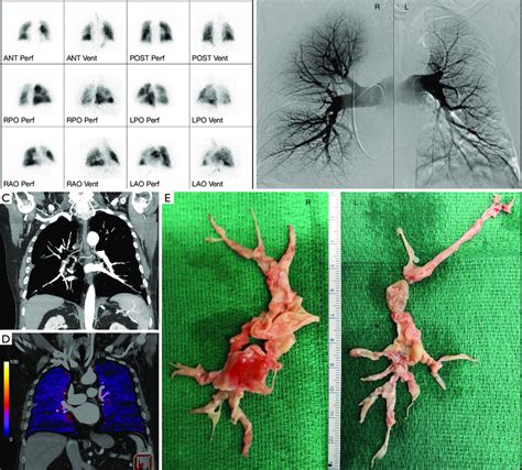 Imaging modalities and resection specimens from a single patient. (A)... | Download Scientific ...