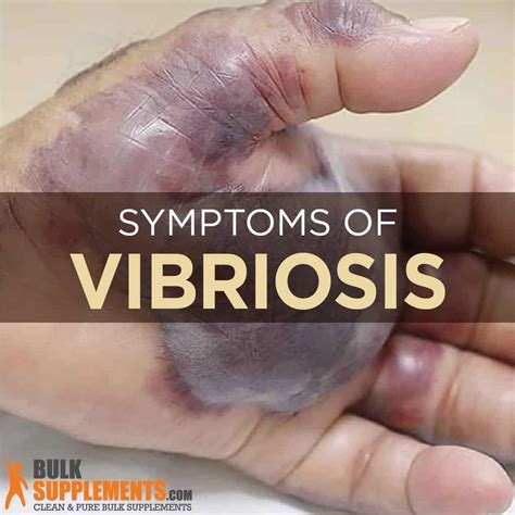 What is Vibriosis: Causes, Symptoms & Treatment