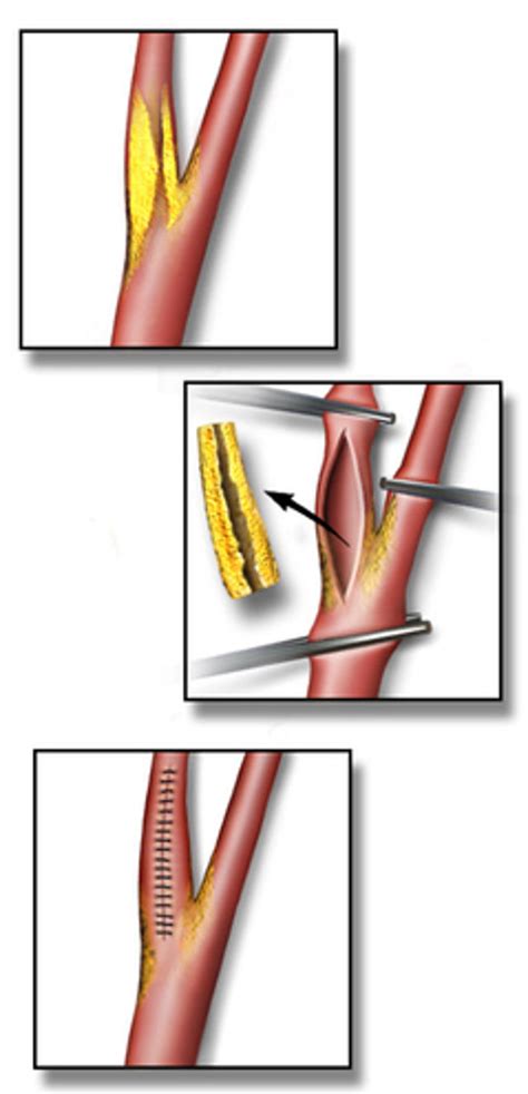 Carotid Endarterectomy