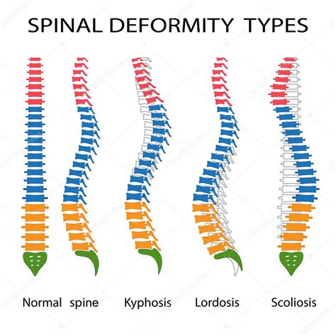 Types de déformation de la colonne vertébrale. — Image vectorielle Neokryuger © #160903368