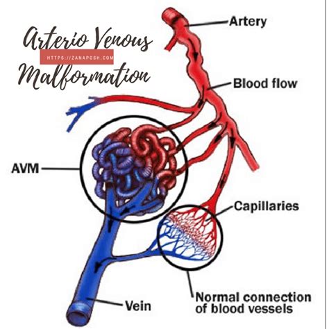 What Is An Arteriovenous Malformation Brain Stuff - vrogue.co