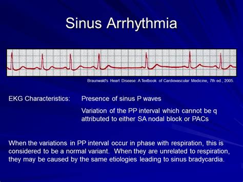 Arrhythmias and EKGs Part 2 Outline Sinus Arrhythmia